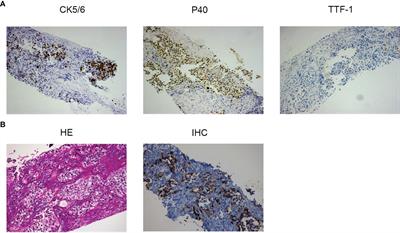 Case Report: Opportunities and Challenges of Immunotherapy in Heavily-Treated EGFR-Mutant Advanced Squamous Cell Lung Carcinoma After Progression on EGFR-TKIs and Chemotherapy